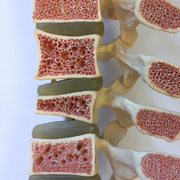 Image for Understanding Osteoporosis: Causes, Risk Factors and Treatment
