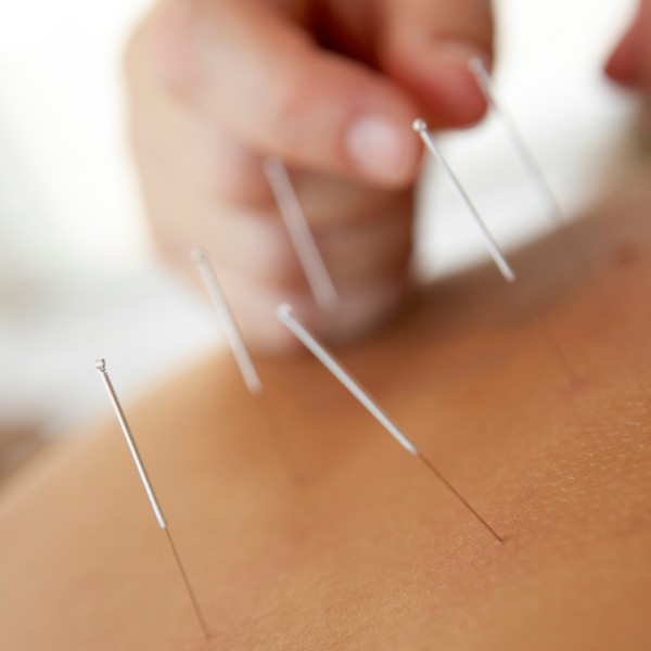 Image for Acupuncture, Cupping and Dry Needling